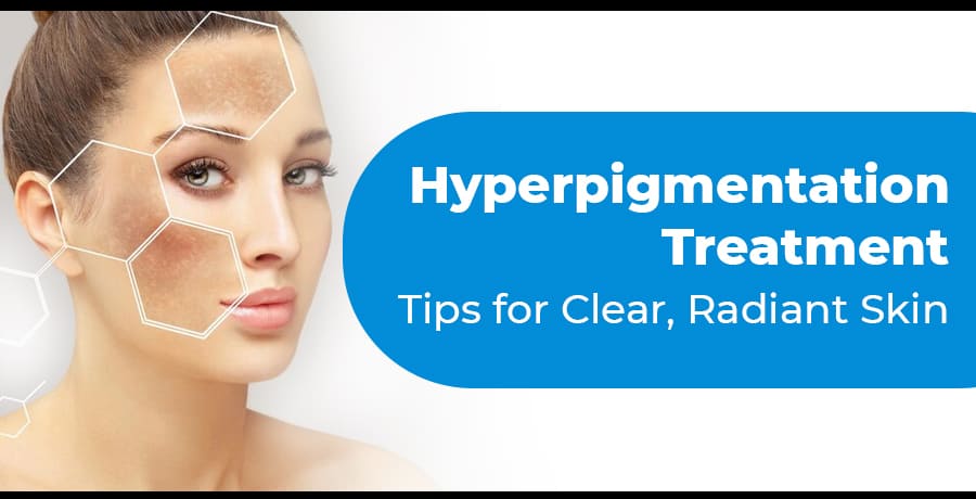hyperpigmentation-treatment-options