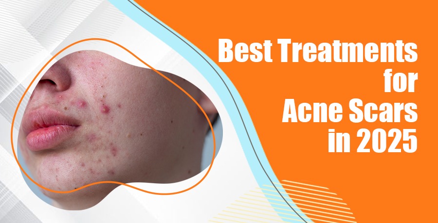 Best Treatments for Acne Scars
