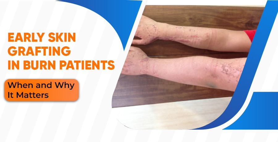 Early Skin Grafting in Burn Patients