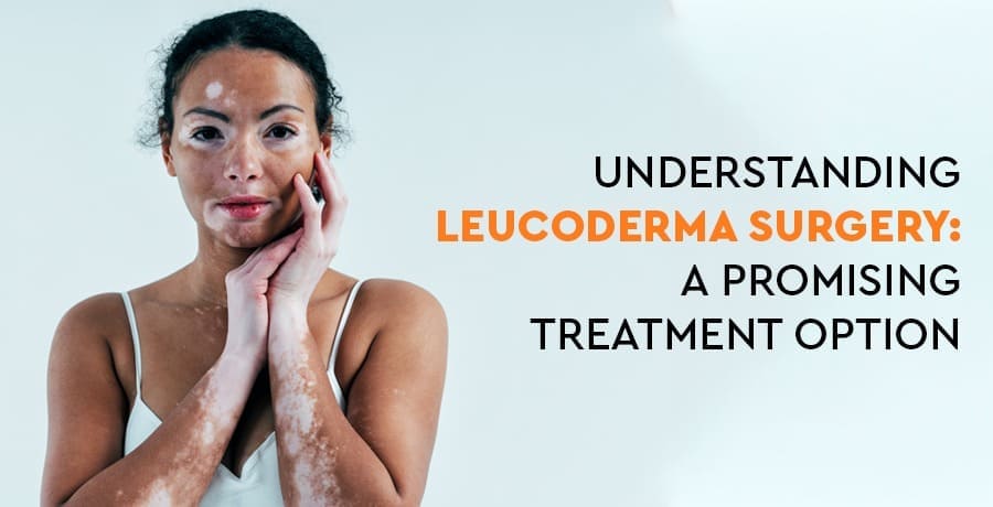 Understanding Leucoderma Treatment