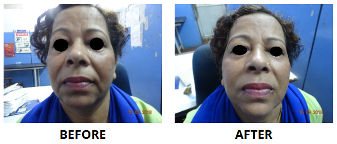 Dermal Fillers