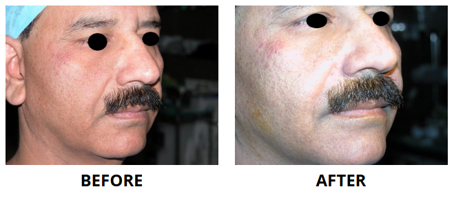 Dermal Fillers