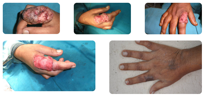 Dermal Regeneration Template