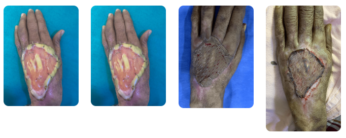 Integra Dermal Regeneration Template (IDRT)