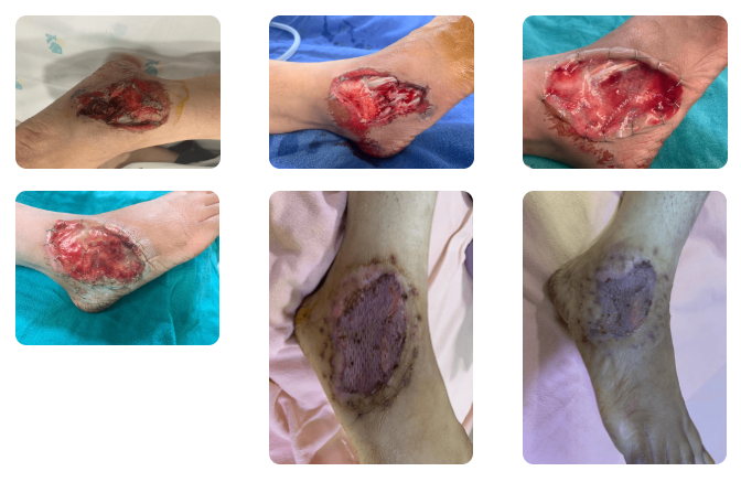 Integra Dermal Regeneration Template (IDRT)