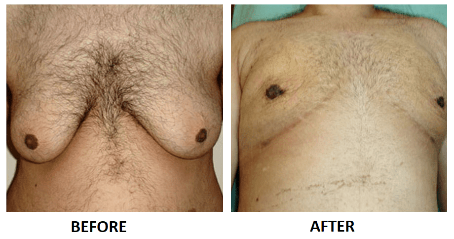 MALE-BREAST-REDUCTION