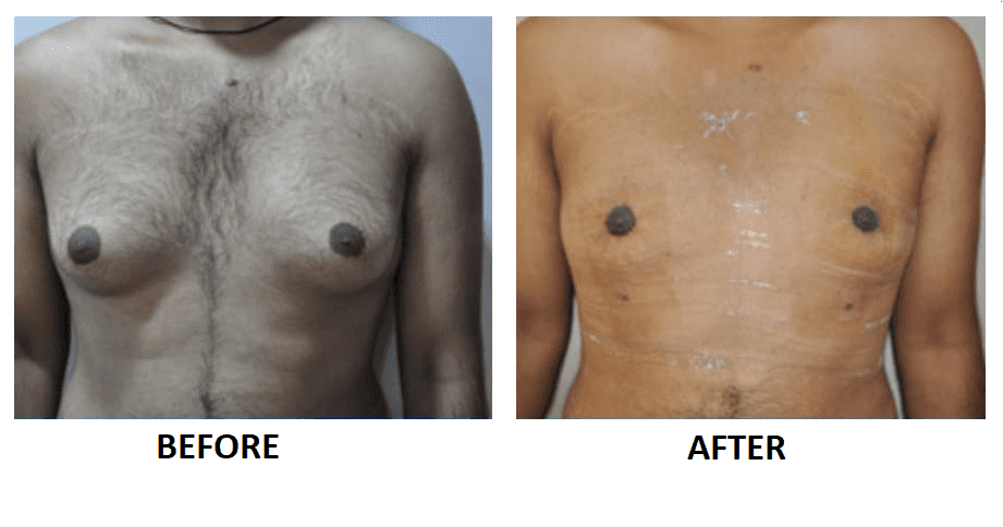 MALE-BREAST-REDUCTION