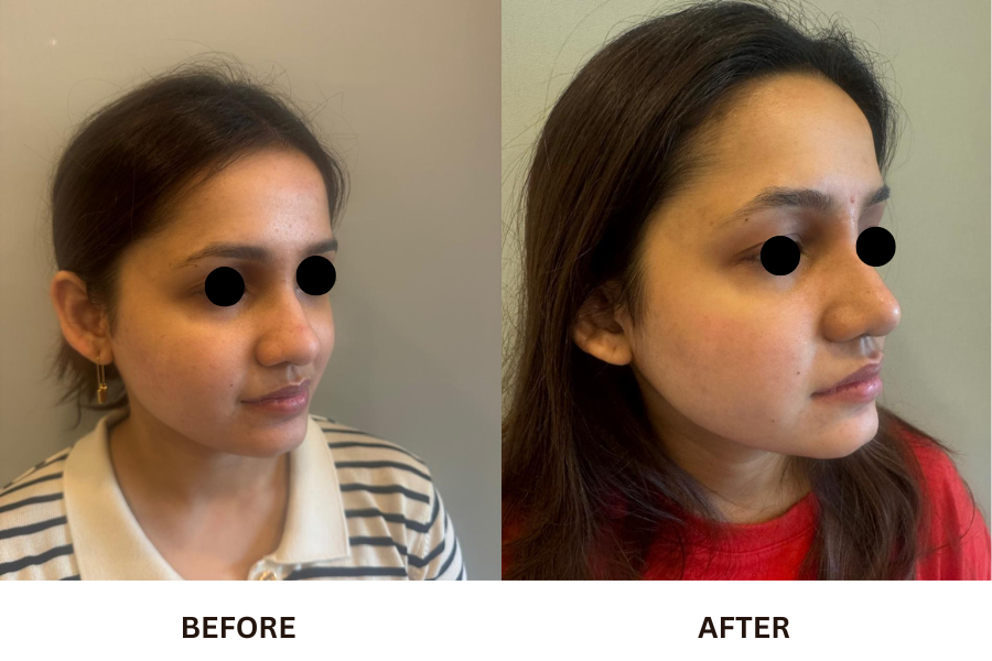 Rhinoplasty & Nose Job