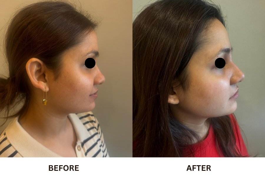 Rhinoplasty & Nose Job