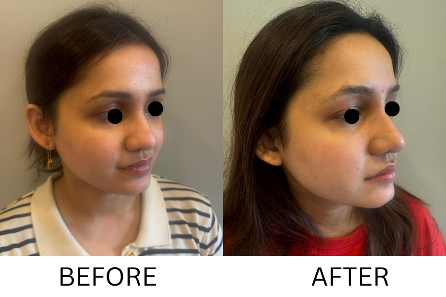 Rhinoplasty & Nose Job