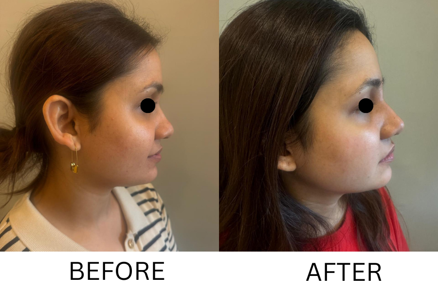 Rhinoplasty & Nose Job