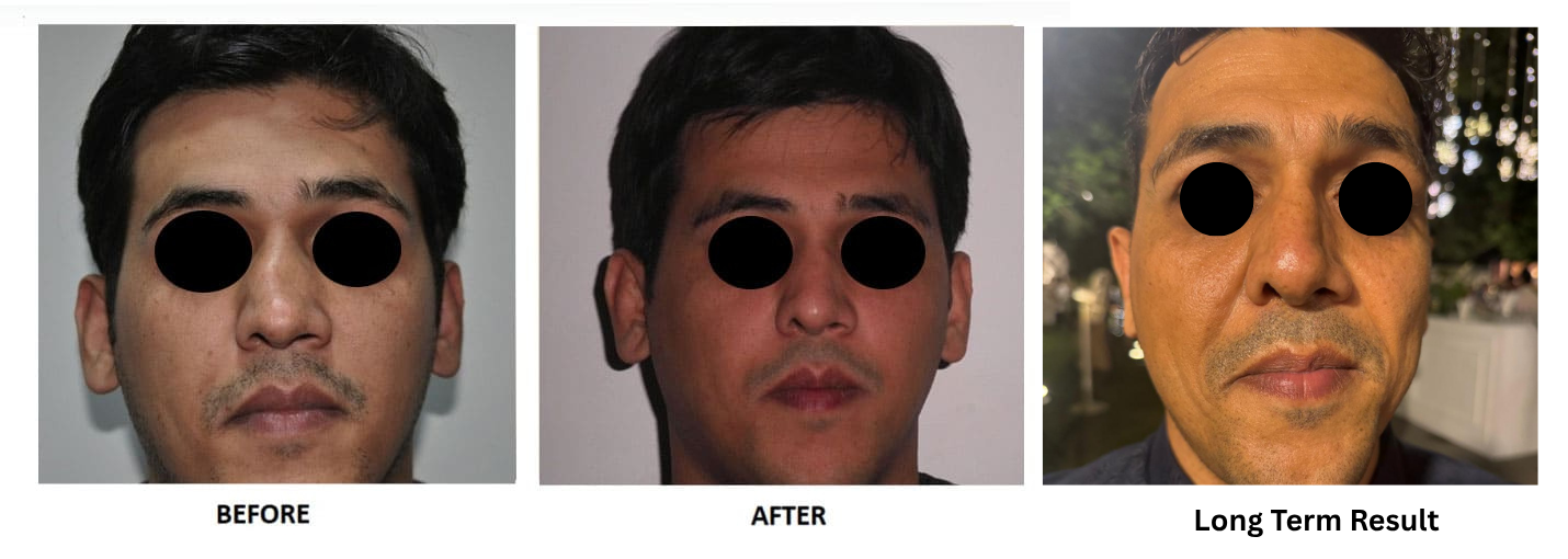 Nose surgery in delhi