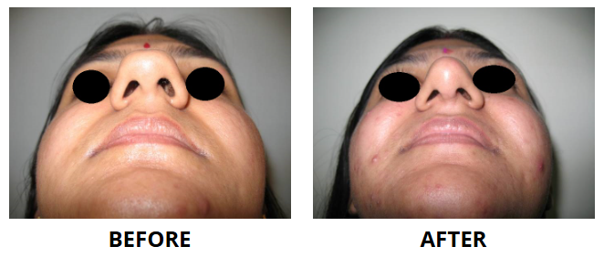 Rhinoplasty & Nose Job