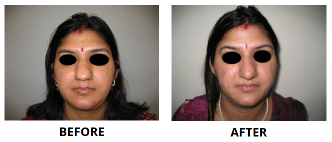 Rhinoplasty & Nose Job