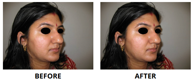Rhinoplasty & Nose Job
