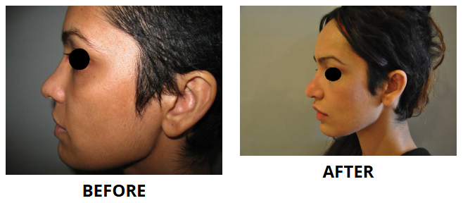 Rhinoplasty & Nose Job
