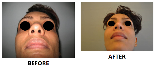 Rhinoplasty & Nose Job