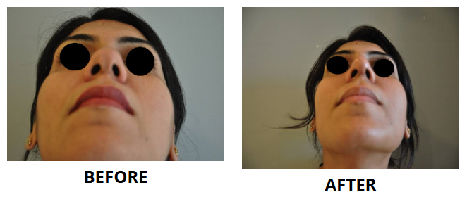 Rhinoplasty & Nose Job