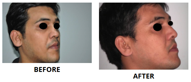 Rhinoplasty & Nose Job