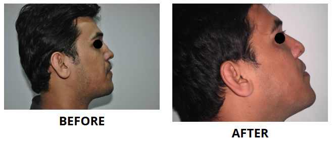 Rhinoplasty & Nose Job