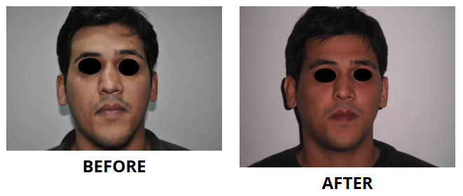 Rhinoplasty & Nose Job