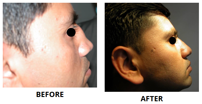 Rhinoplasty & Nose Job