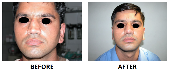 Rhinoplasty & Nose Job