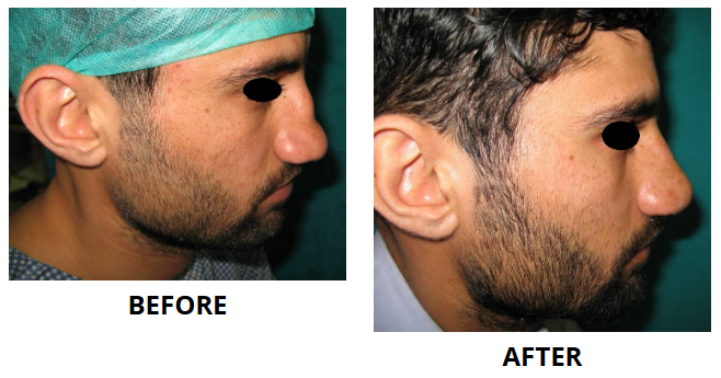 Rhinoplasty & Nose Job