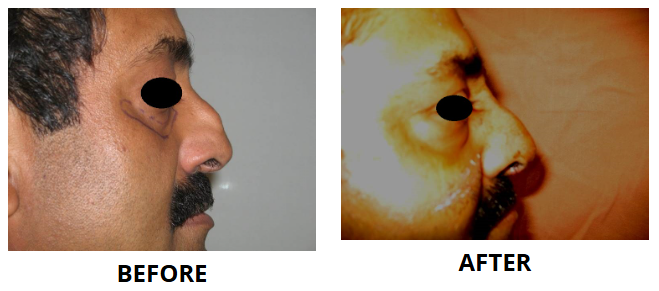 Rhinoplasty & Nose Job