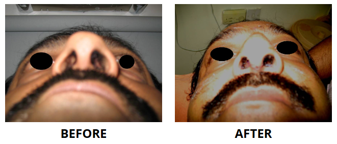 Rhinoplasty & Nose Job