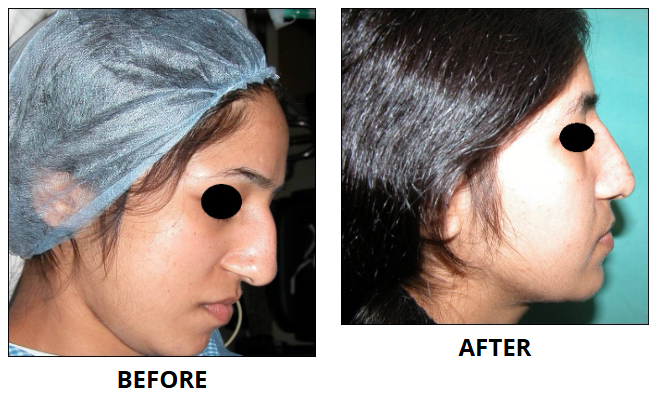 Rhinoplasty & Nose Job