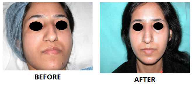 Rhinoplasty & Nose Job