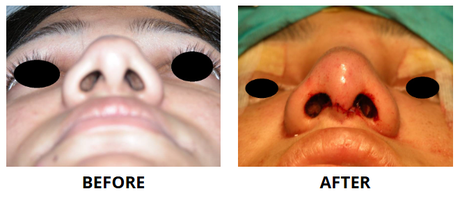 Rhinoplasty & Nose Job