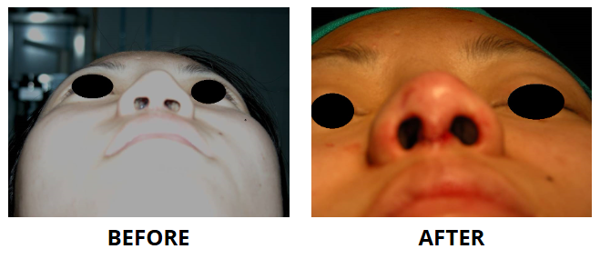 Rhinoplasty & Nose Job