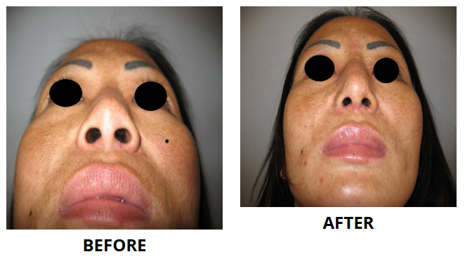 Rhinoplasty & Nose Job