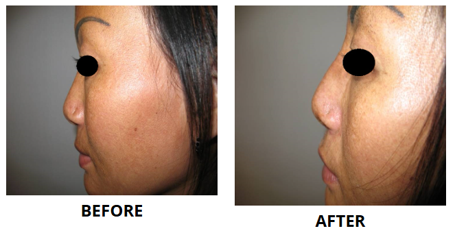 Rhinoplasty & Nose Job