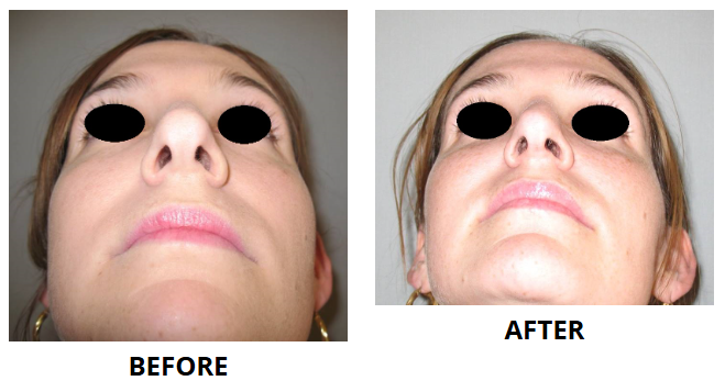 Rhinoplasty & Nose Job