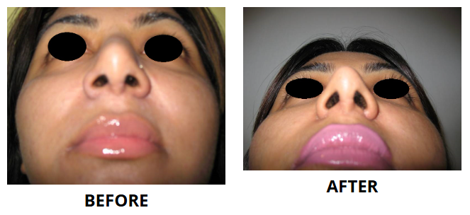 Rhinoplasty & Nose Job
