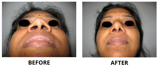 Rhinoplasty & Nose Job