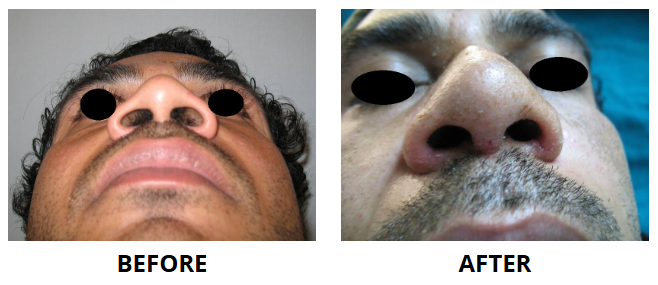 Rhinoplasty & Nose Job