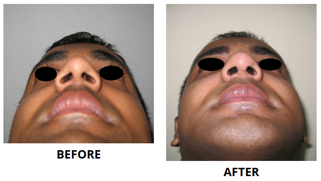 Rhinoplasty & Nose Job