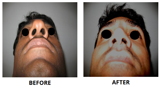 Rhinoplasty & Nose Job