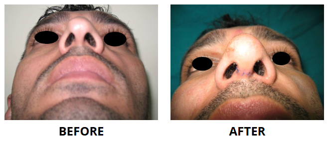 Rhinoplasty & Nose Job