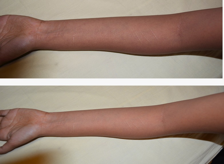 Fat Grafting for Self Injury Marks