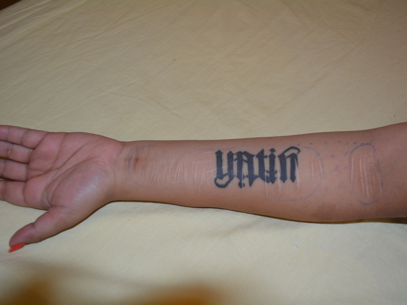 Tattoo & Self-injury Mark Removal