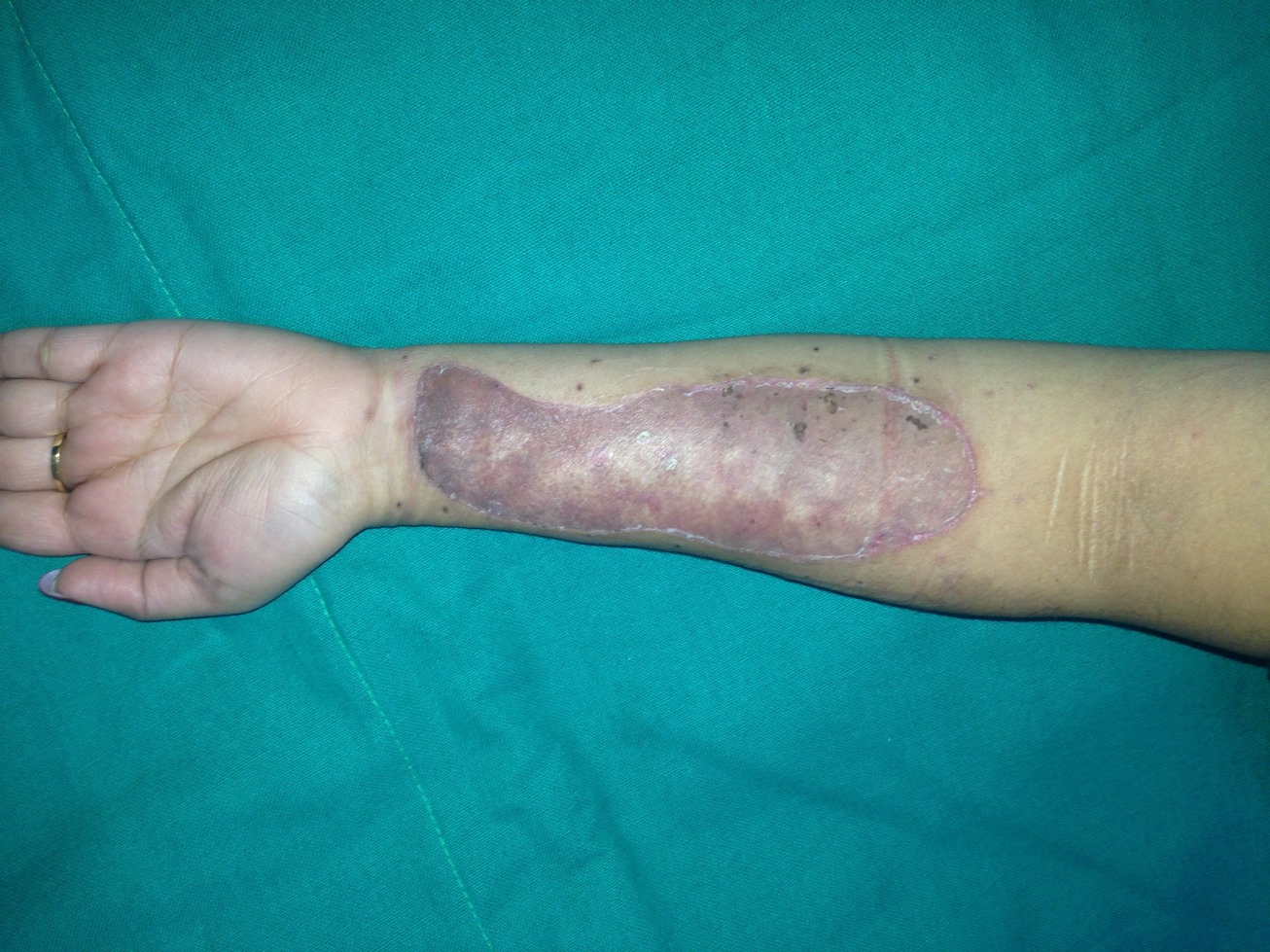 Tattoo & Self-injury Mark Removal
