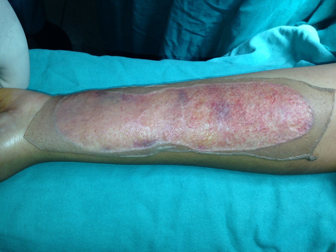 Tattoo & Self-injury Mark Removal