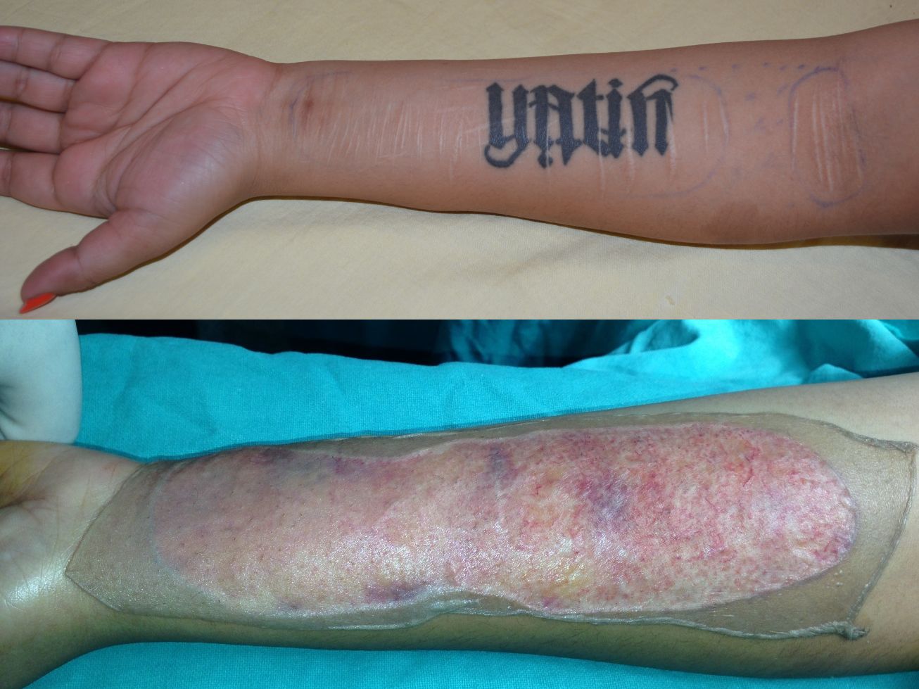 Tattoo & Self-injury Mark Removal