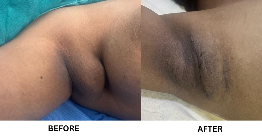Axillary Breast Treatment