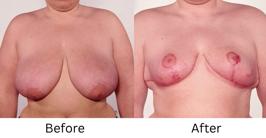 Breast Reduction